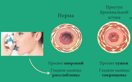 астма